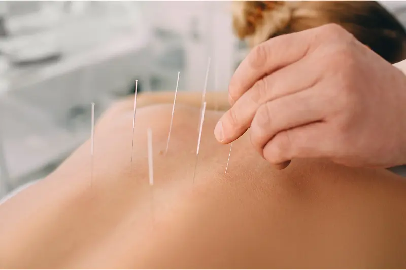 dry needling acupuncture